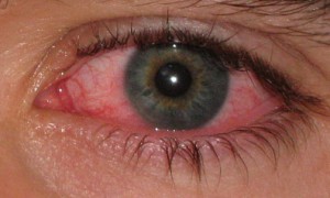 Pink Eye (Conjunctivitis) – All About Eyes