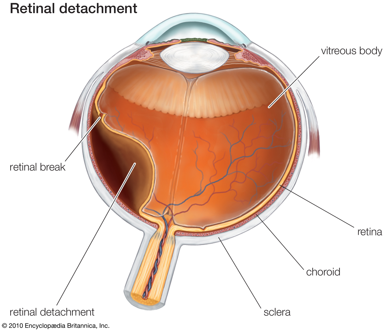 myopia-on-the-rise-can-retinal-detachment-be-far-behind-all-about-eyes